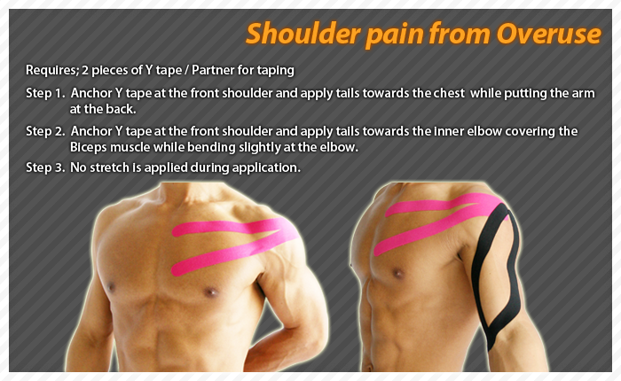 ares clinical taping - overuse